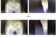 正确医疗模式造就世界奇迹 四川省骨科医院成功为112岁高龄患者实施全髋关节置换手术